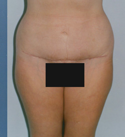 Tummy Tucks (Abdominoplasty) Patient 68964 After Photo # 2