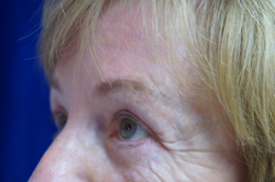 Eyelid Surgery Patient 32850 After Photo # 6
