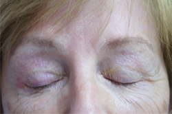 Eyelid Surgery Patient 32850 After Photo # 4