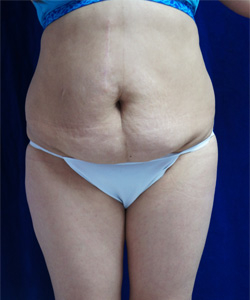 Tummy Tucks (Abdominoplasty) Patient 77291 Before Photo # 1