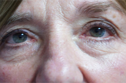 Eyelid Surgery Patient 53230 Before Photo # 1