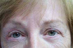 Eyelid Surgery Patient 32850 After Photo # 2