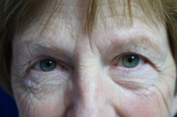 Eyelid Surgery Patient 32850 Before Photo # 1