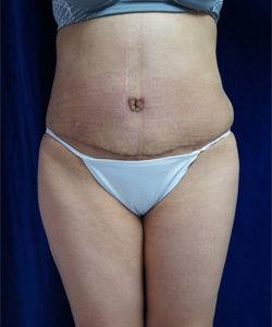 Tummy Tucks (Abdominoplasty) Patient 77291 After Photo # 2