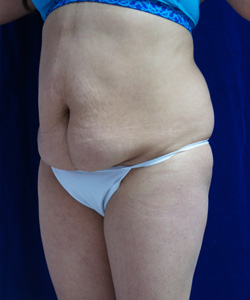 Tummy Tucks (Abdominoplasty) Patient 77291 Before Photo # 3