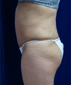 Tummy Tucks (Abdominoplasty) Patient 77291 After Photo # 6