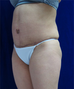 Tummy Tucks (Abdominoplasty) Patient 77291 After Photo # 4