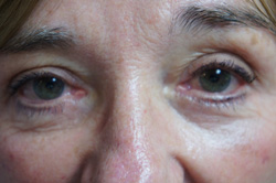 Eyelid Surgery Patient 53230 After Photo # 2