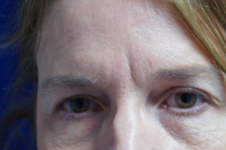 Eyelid Surgery Patient 80575 Before Photo # 1