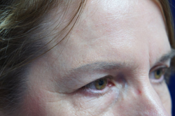 Forehead Lift Patient 13871 Before Photo # 3