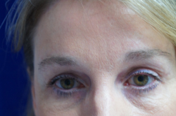 Forehead Lift Patient 13871 After Photo # 2