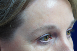 Forehead Lift Patient 13871 After Photo # 4