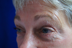 Forehead Lift Patient 22372 After Photo # 4