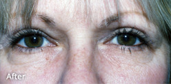 47-year-old one year after upper eyelid surgery.
